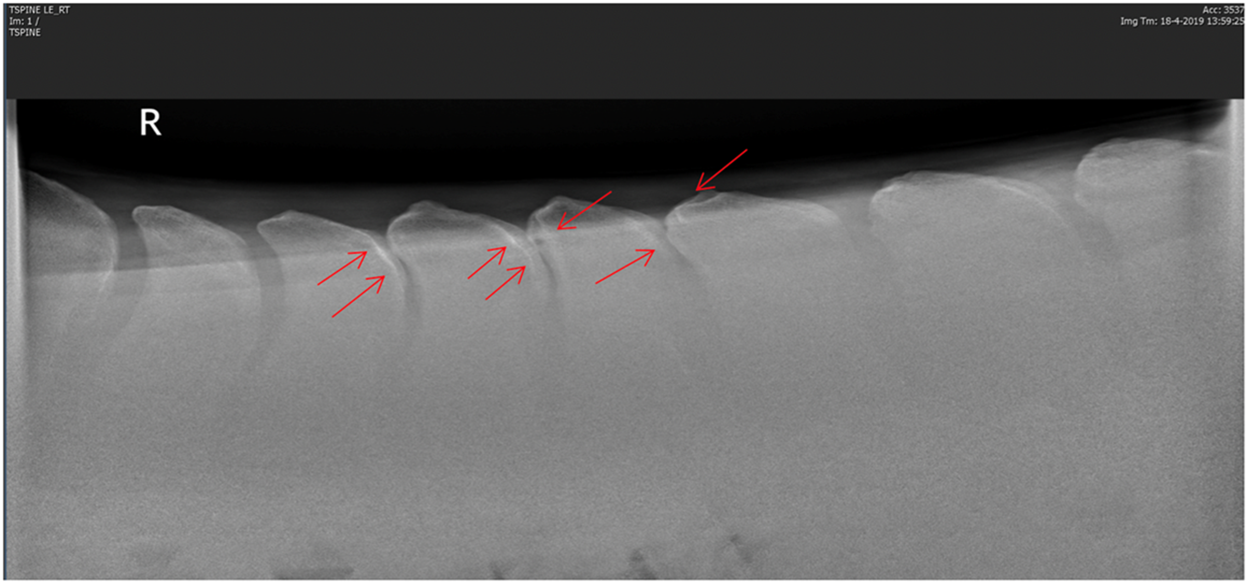 X-ray of kissing spines