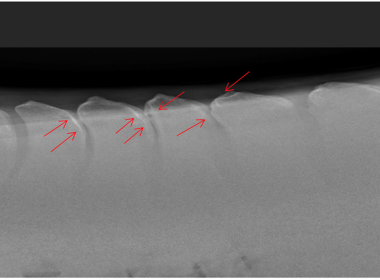 X-ray of kissing spines